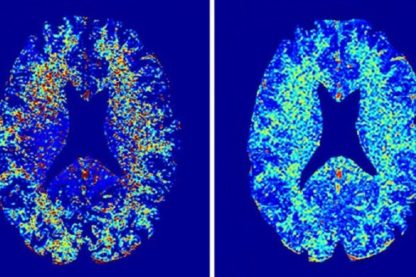irm cerveau myeline