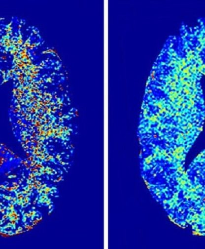 irm cerveau myeline