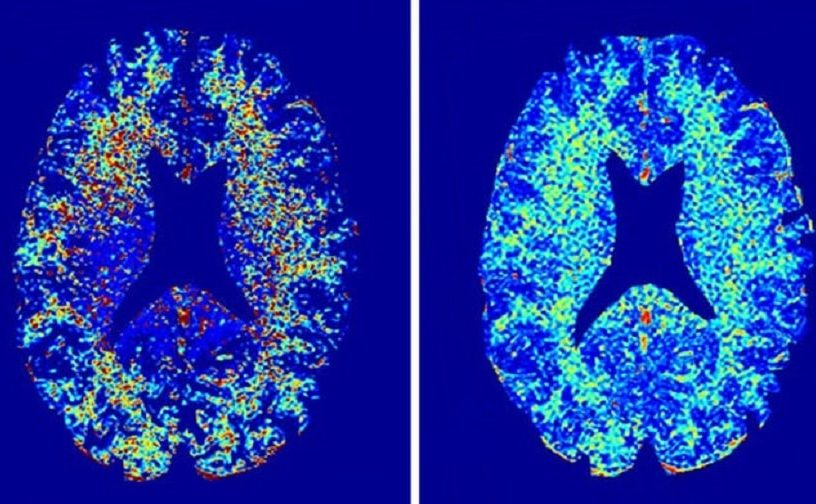 irm cerveau myeline