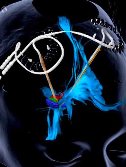 stimulation cerebrale profonde depression