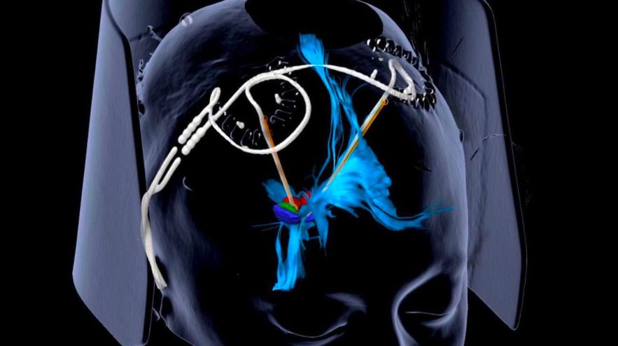 stimulation cerebrale profonde depression