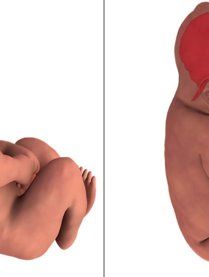 distorsion cerveau bebe