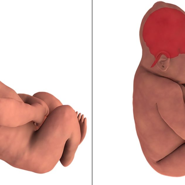 distorsion cerveau bebe