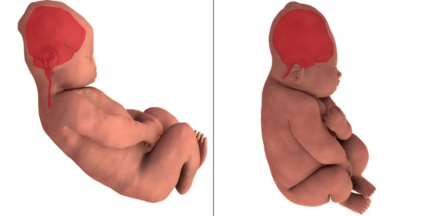 distorsion cerveau bebe