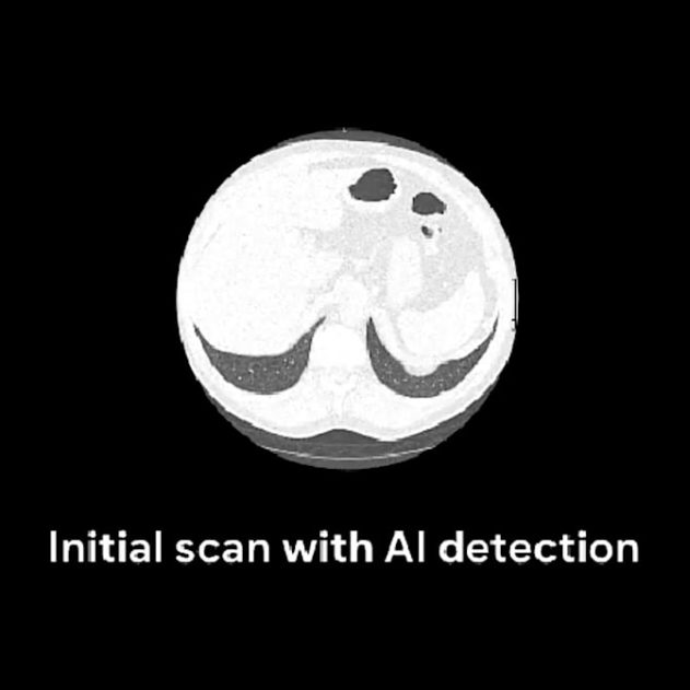 google ia irm diagnostic cancer poumon