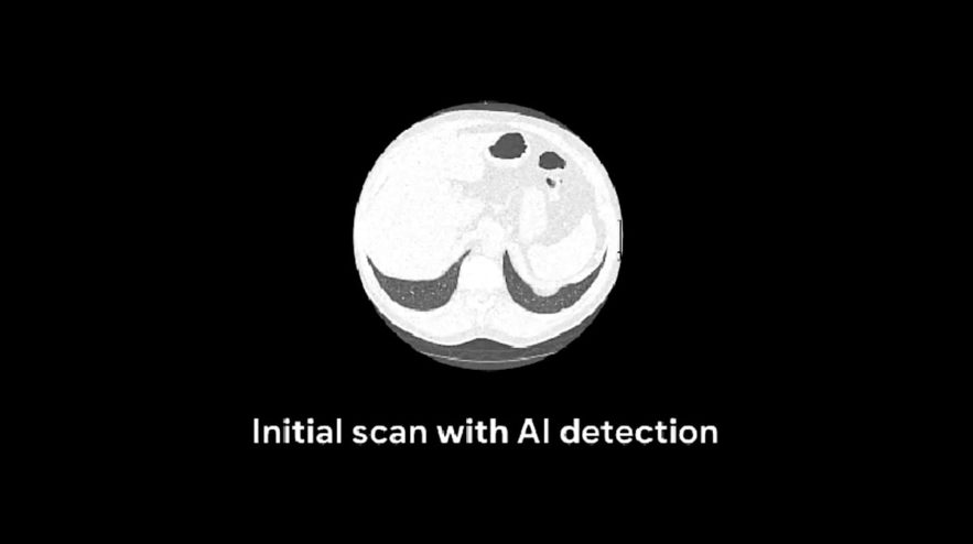 google ia irm diagnostic cancer poumon