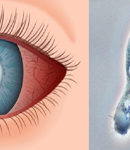 lentilles contact cecite