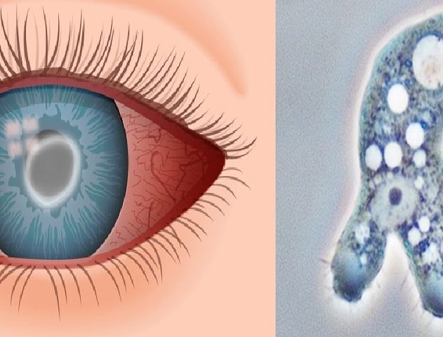 lentilles contact cecite