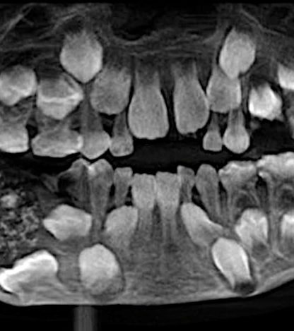radiographie 500 dents enfant indien