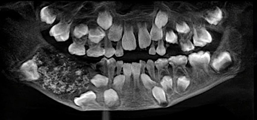 radiographie 500 dents enfant indien