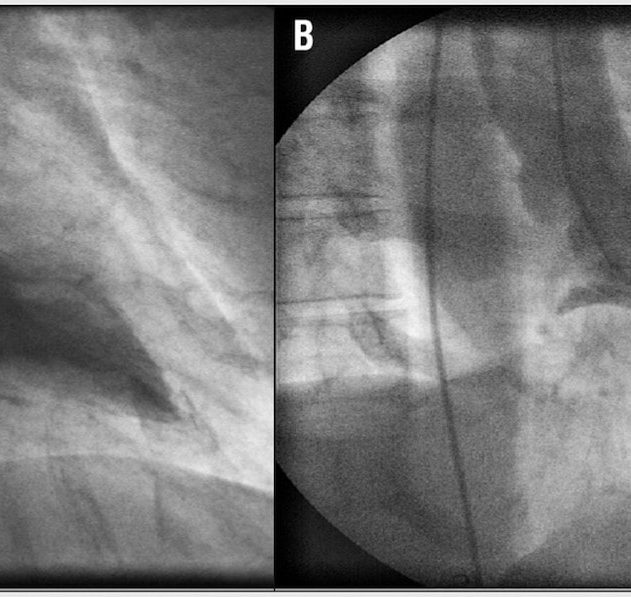 syndrome takotsubo lien avec connexions cerebrales
