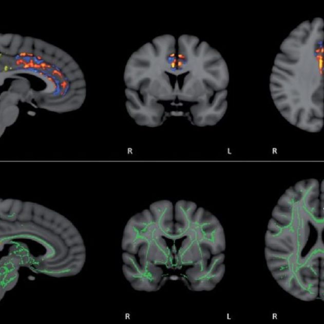 alzheimer memorem
