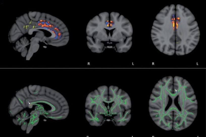 alzheimer memorem