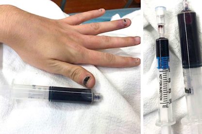 gel anesthesique rend sang femme bleu