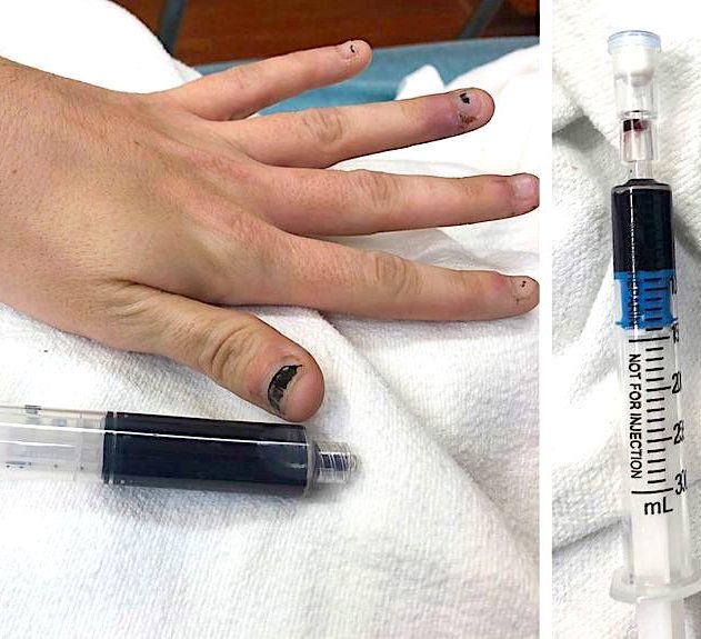 gel anesthesique rend sang femme bleu