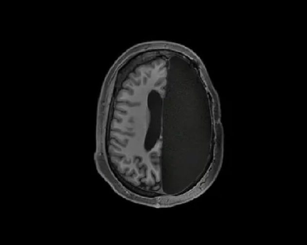 hemisphere cerveau