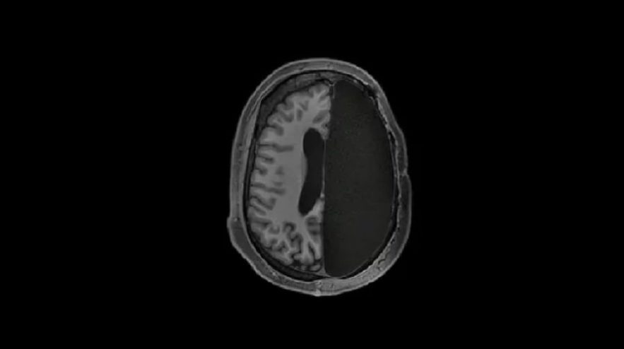 hemisphere cerveau