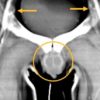 patient-radio-transplantation-greffe-penis-organes-genitaux