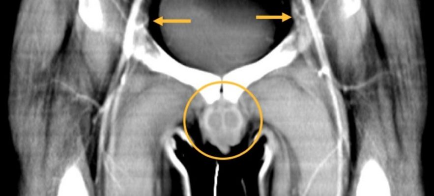 patient-radio-transplantation-greffe-penis-organes-genitaux