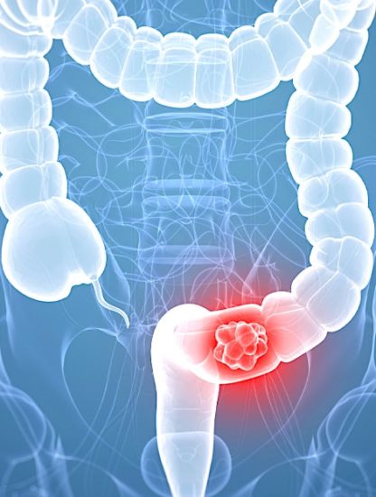 cancer colorectal nouvelle cible therapeutique 2019