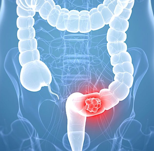 cancer colorectal nouvelle cible therapeutique 2019
