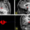 hypothalamus-cerveau-femmes-pilule-contraceptive-contraception-orale-hormonale
