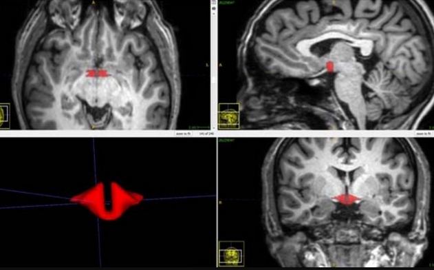 hypothalamus-cerveau-femmes-pilule-contraceptive-contraception-orale-hormonale