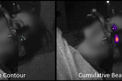 effet tcherenkov oeil radiotherapie