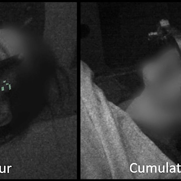 effet tcherenkov oeil radiotherapie