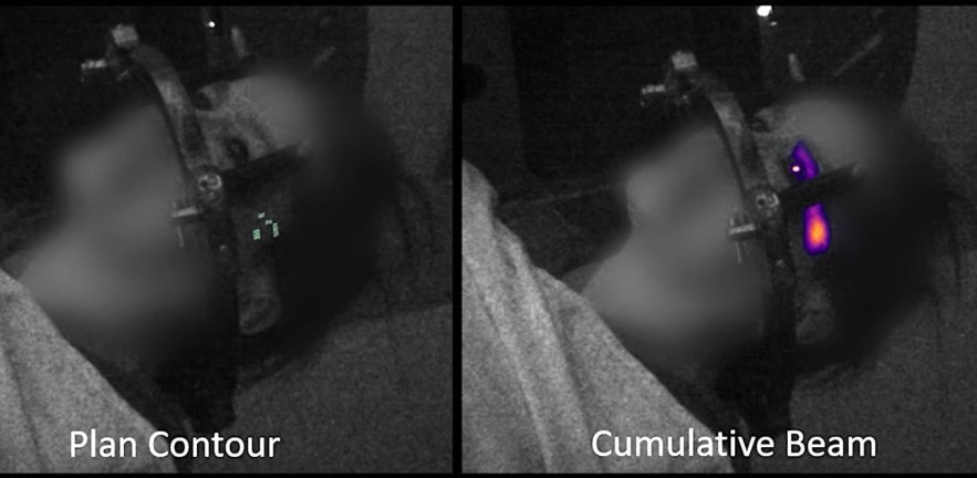 effet tcherenkov oeil radiotherapie