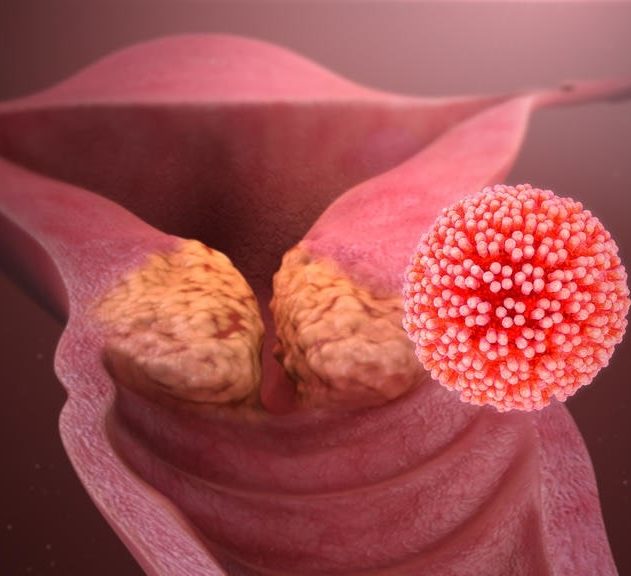 elimination hpv