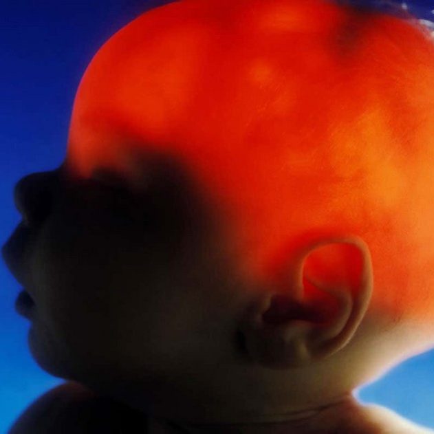 cerveau manquant partie hemisphere gauche
