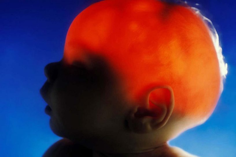 cerveau manquant partie hemisphere gauche