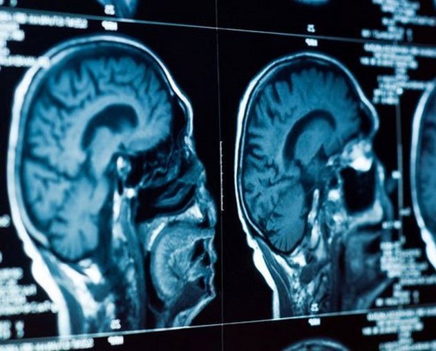 depression cerveau