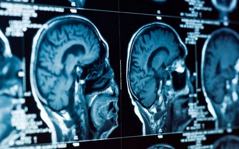 depression cerveau