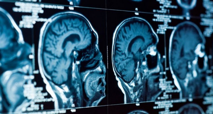 depression cerveau