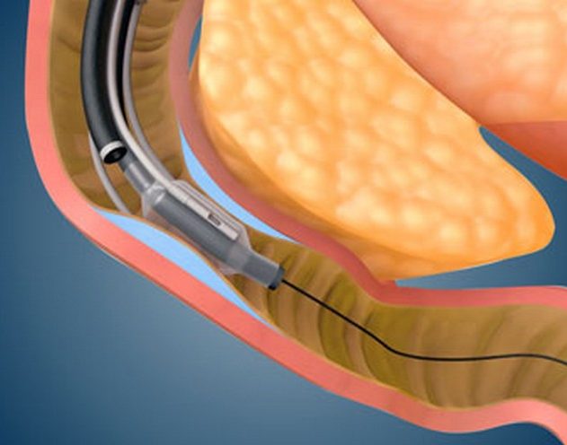 diabete fractyl