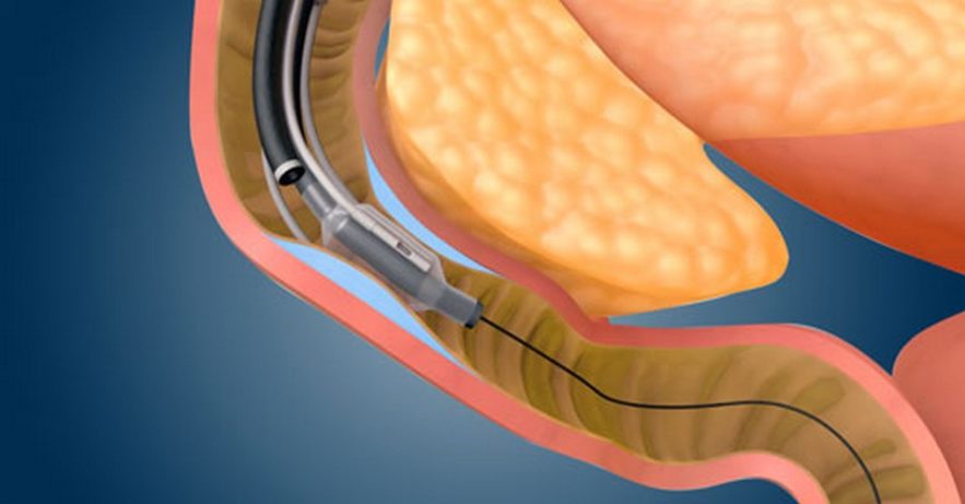 diabete fractyl