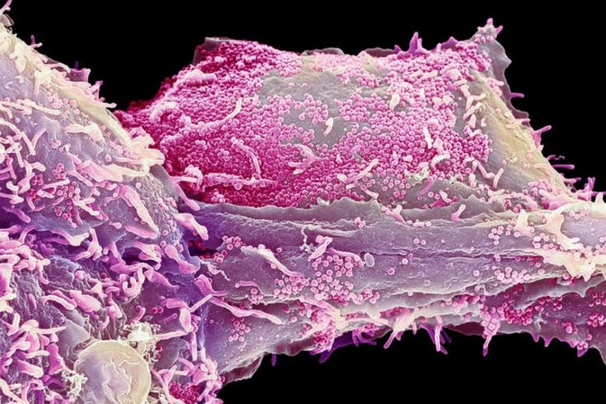 cellule herpès alzheimer