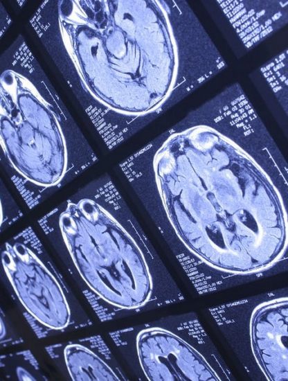coronavirus cerveau covid19 neurologie
