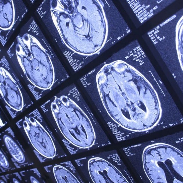 coronavirus cerveau covid19 neurologie