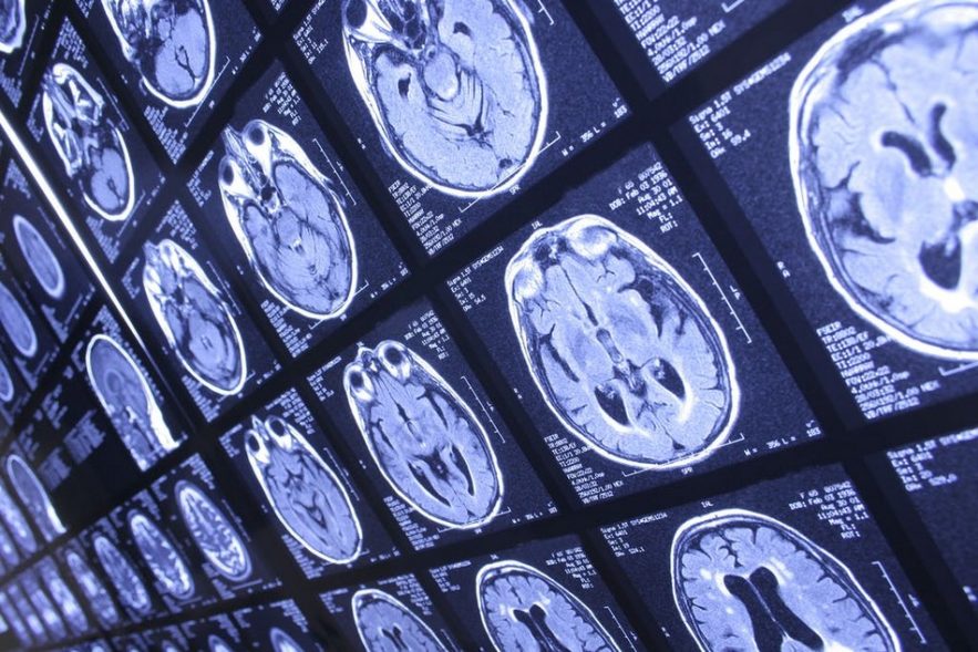 coronavirus cerveau covid19 neurologie