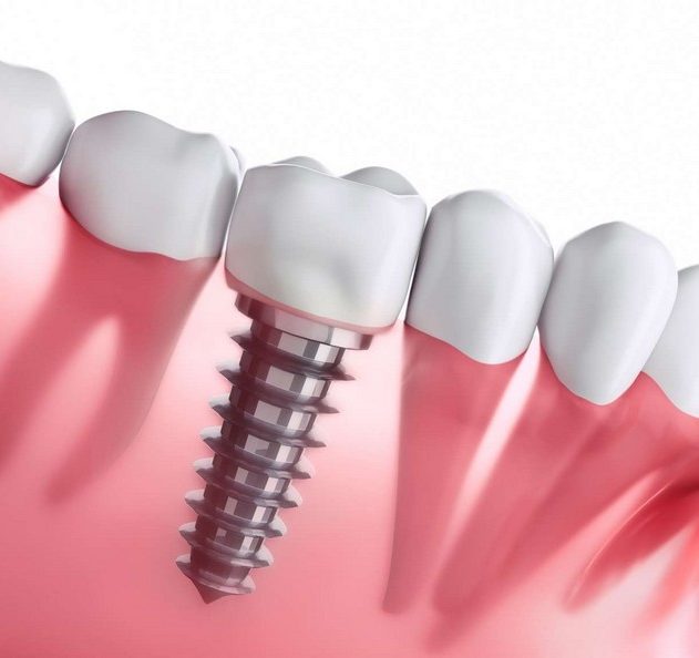 implant dentaire