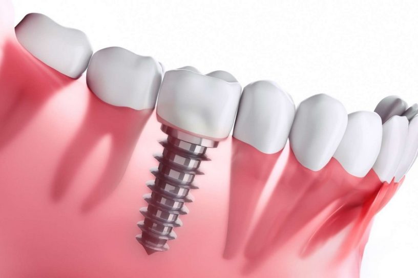 implant dentaire