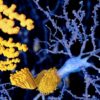 beta amyloide alzheimer maladie