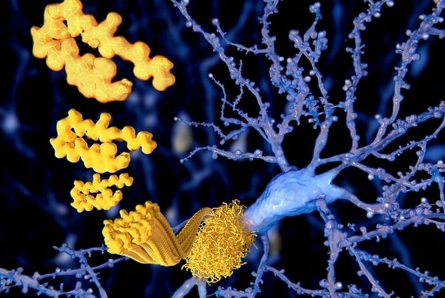 beta amyloide alzheimer maladie