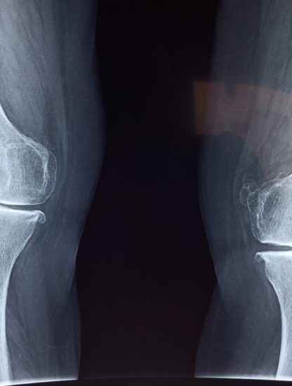 hydrogel remplacement cartilage genoux