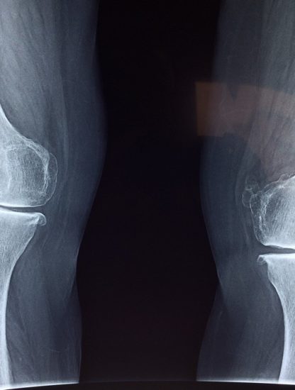 genou radio cartilage