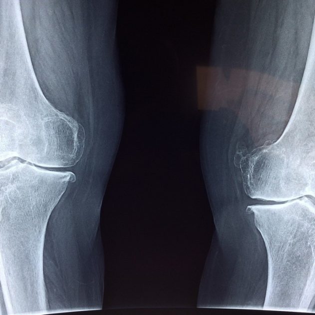 genou radio cartilage