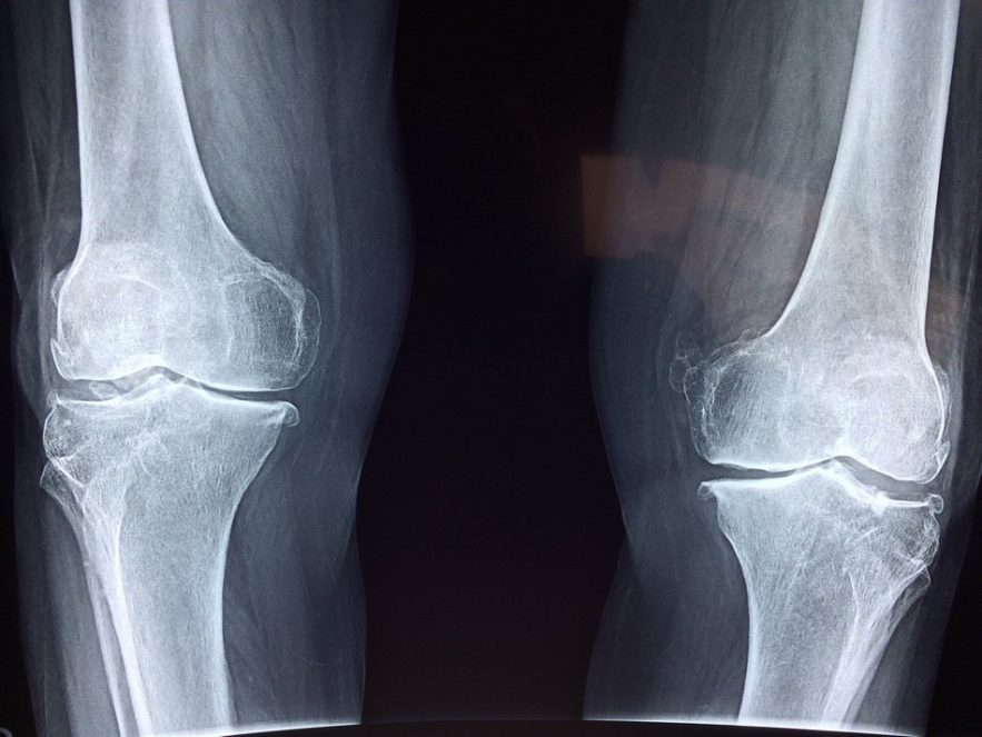 genou radio cartilage
